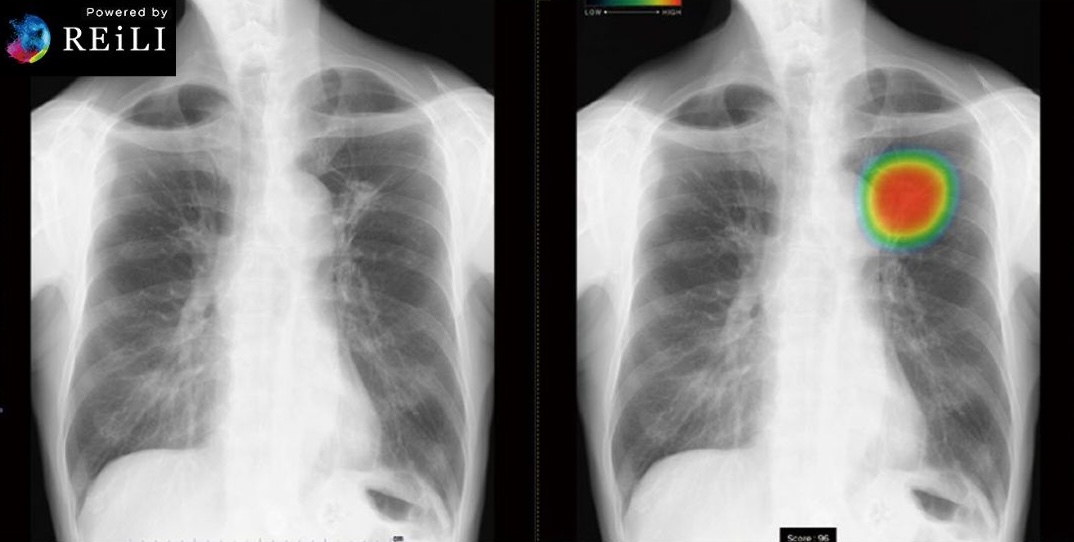 CXR-AI